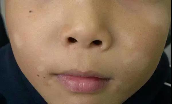 孩子脸上有白斑是怎么回事？