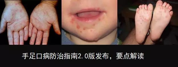国家卫健委发布《手足口病诊疗指南2018版》
