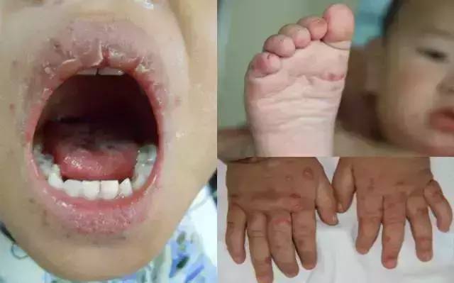 孩儿乐教你识手足口病